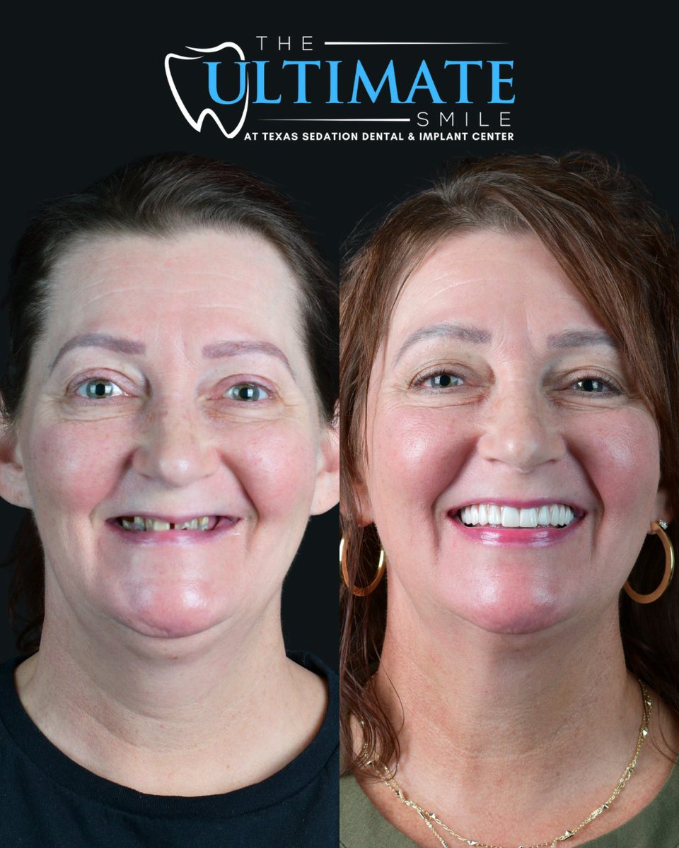 TXSedationDent's tweet image. What’s the first thing you’d do if you had a strong, healthy smile you felt confident showing off?

#dentalimplants #fixedteeth #dentures #theultimatesmile #newsmilenewlife #glowup
