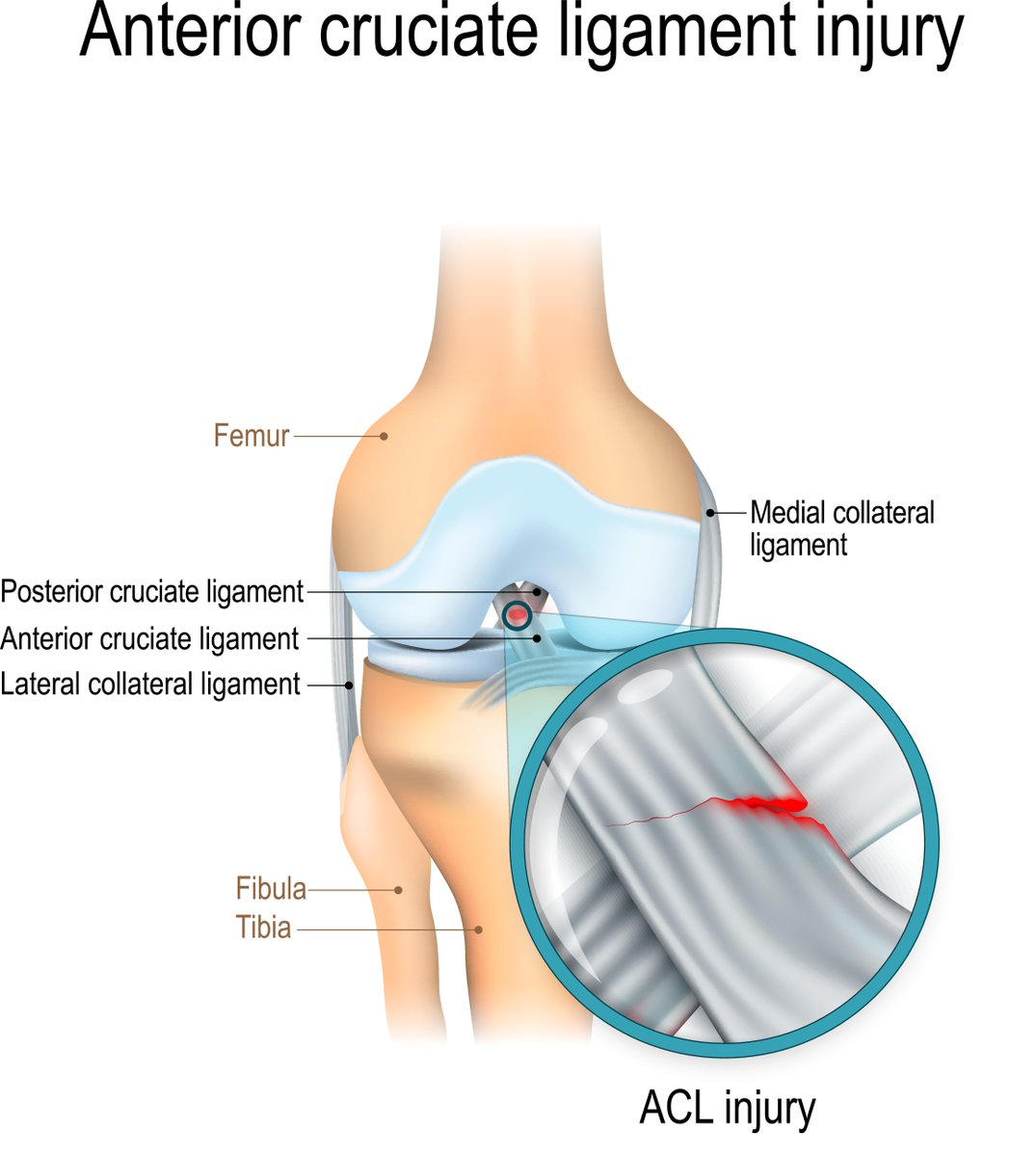 FMPA_Register's tweet photo. FMPA EDUCATION:

🦵Non-operative treatment of ACL injuries

🔓 FMPA Member free access to BJSM article

➡️ https://t.co/boneoeLVDN https://t.co/wqnjcKLnc6