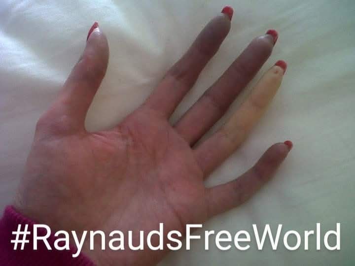 RaynaudsRf's tweet image. October #RaynaudsAwarenessMonth
raynaudsrf.blogspot.com/2019/10/the-ra… 
Raynaud's Awareness:
raynaudsrf.blogspot.com/2020/03/raynau… 
#RaynaudsFreeWorld #Research #Raynauds 
justgiving.com/fundraising/ra…
#Vasospasm #BlueFingers #BlueToes #DigitalUlcers #Gangrene #Amputation  #VascularNeuropathy #BePartOfResearch
