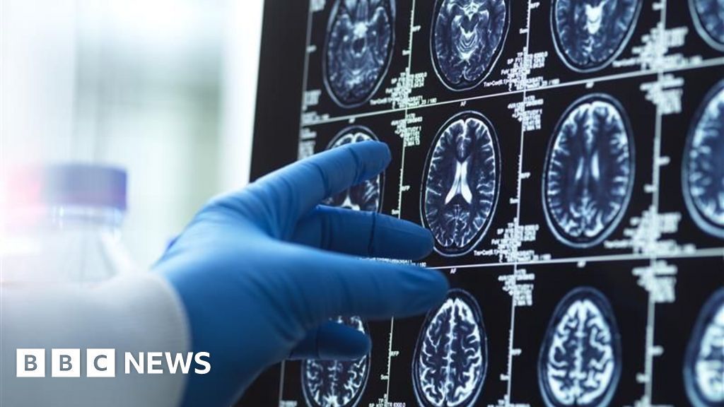 DiverseElders's tweet image. Artificial intelligence (AI) is being used to help diagnose #dementia more quickly and accurately in a new study, which combines #blood tests to detect #biomarkers associated with early signs of #Alzheimer's. AI is then used to pull the results together. buff.ly/P8zSiPk