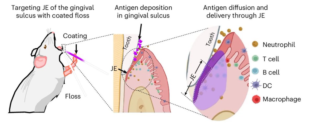 フロスにワクチン塗ったら歯肉溝（＝歯周ポケットの元）から成分が取り込まれてめっちゃいい感じに全身免疫（IgG）も粘膜免疫（IgA）も誘導できたよ from Nat Biomed Eng

みんなおもしろいこと考えててすごいなぁ
nature.com/articles/s4155…