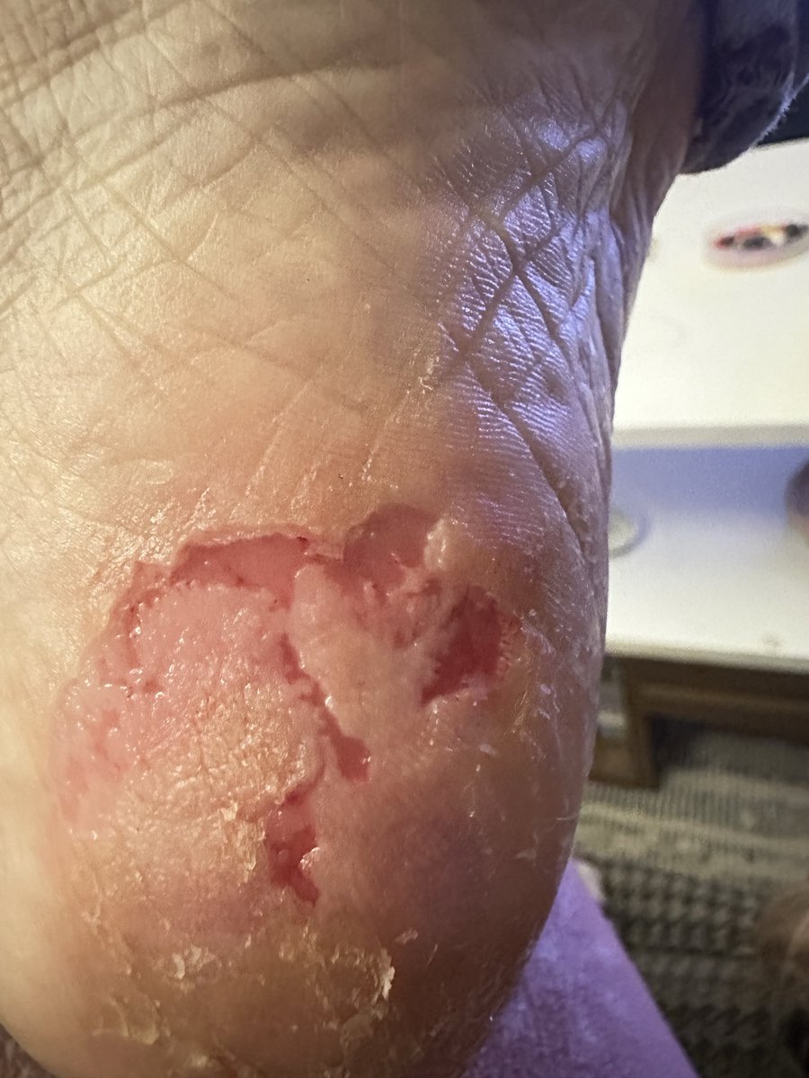 laila_glz's tweet image. 💔 Sesimi duyan var mı?..
Ben kanser hastasıyım… Tedavim hâlâ devam ediyor, akıllı ilaç kullanıyorum ama hastalık karaciğerime kadar metastaz yaptı. Ellerim ve ayaklarım yara içinde, çoğu zaman acıdan bir şey tutamıyor, takı yaparken bile gözyaşlarımla çalışıyorum…
Doktorlar…
