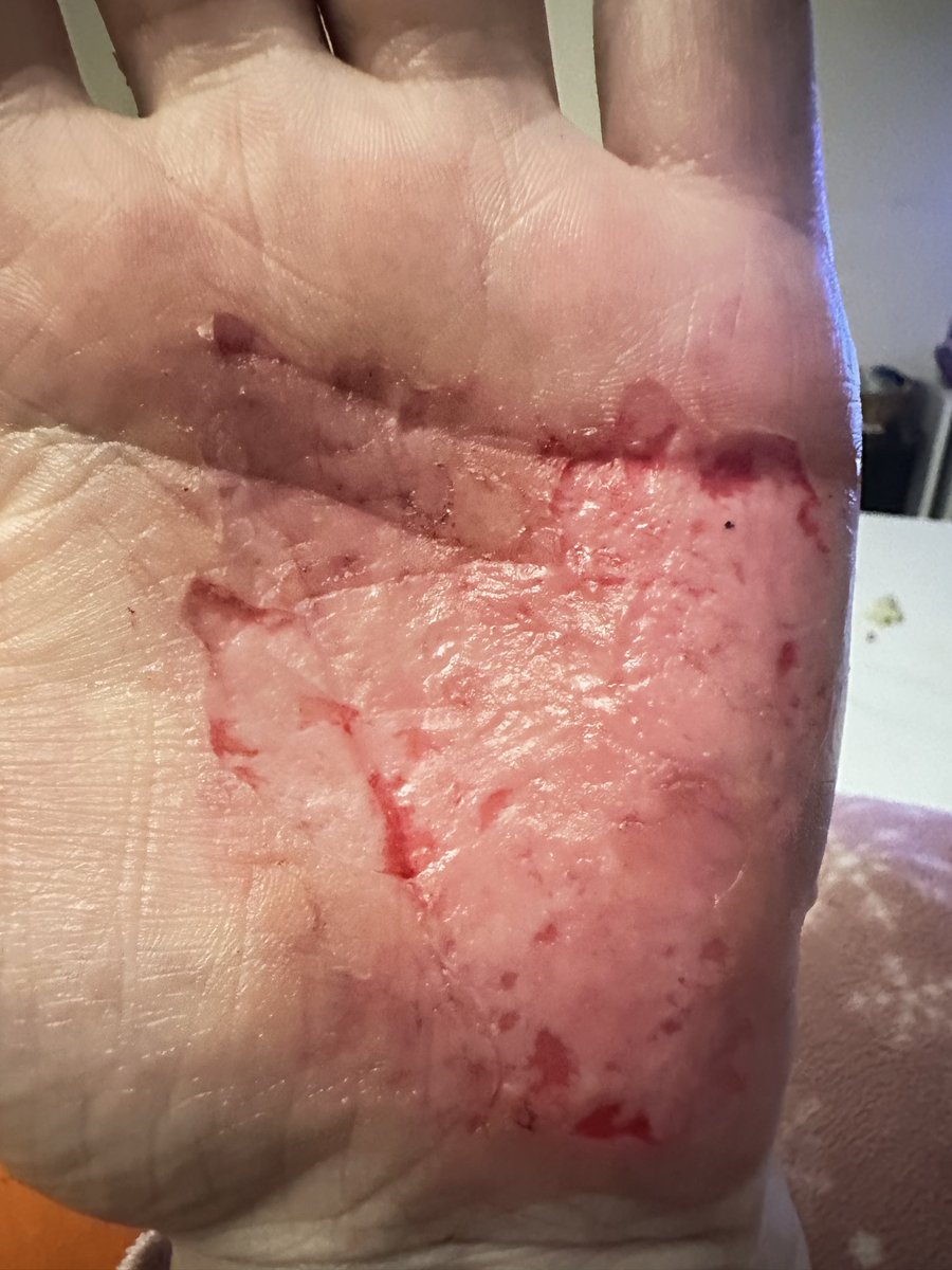 laila_glz's tweet image. 💔 Sesimi duyan var mı?..
Ben kanser hastasıyım… Tedavim hâlâ devam ediyor, akıllı ilaç kullanıyorum ama hastalık karaciğerime kadar metastaz yaptı. Ellerim ve ayaklarım yara içinde, çoğu zaman acıdan bir şey tutamıyor, takı yaparken bile gözyaşlarımla çalışıyorum…
Doktorlar…