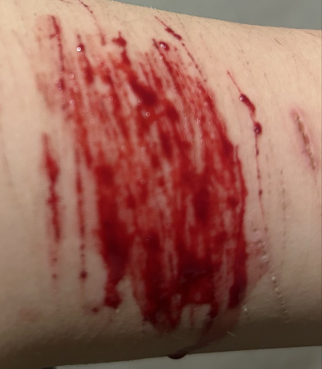 LikeToast40802's tweet photo. Can we appreciate these cuts (these were in September) #selfharmm #shtwt #shedtwt #selfinjuryy #blood  #styros #annie #deb #depression #988twt #suicidetwt #cuts https://t.co/AThfOR1vZ0