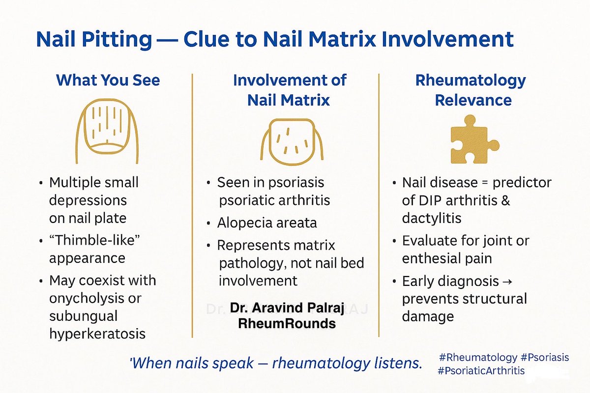 Rheumat_Aravind's tweet image. When nails tell the story 💅
Nail pitting isn’t just cosmetic - it signals nail matrix inflammation, often in psoriasis or psoriatic arthritis.
Always check the joints before the damage sets in.
“When nails speak - rheumatology listens.”
#Rheumatology #Psoriasis…