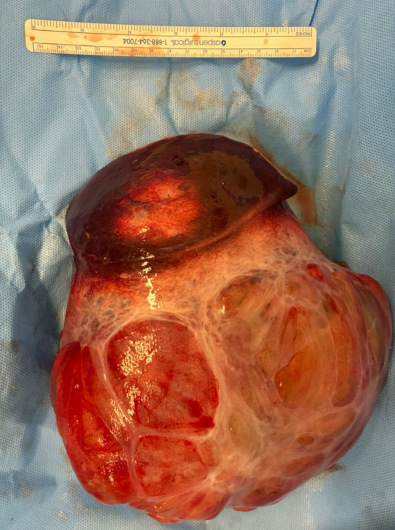 FelipePatologia's tweet image. Liver, 2 yo female

Solid and cystic large lesion

Notice the loose connective tissue and epithelial bile ducts arranged in lobulated islands and also the lymphangioma-like spaces.

Diagnosis: Mesenchymal hamartoma

#liver #hepatic #PediPath