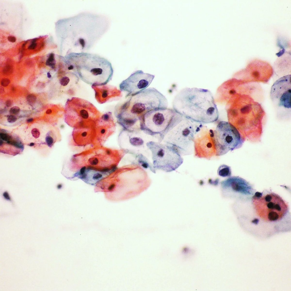 Find the difference between the George Papanicolaou's atlas and this cervical cytology (conventional).