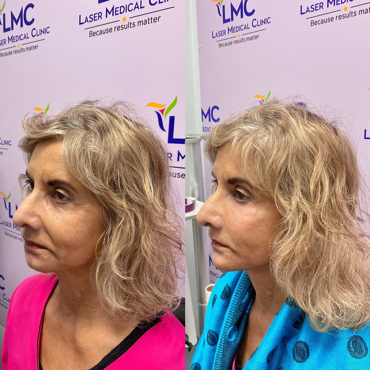 lmclaser's tweet photo. it’s not filler. it’s you ✨
our all-natural prp filler uses your own growth factors to lift, smooth &amp; glow — no synthetics, just regeneration from within 💉🌿

#prpfiller #naturalresults #bioregenerativeaesthetics #skinrejuvenation #toronto #the6ix #lasermedicalclinic https://t.co/CQipwUKSIx