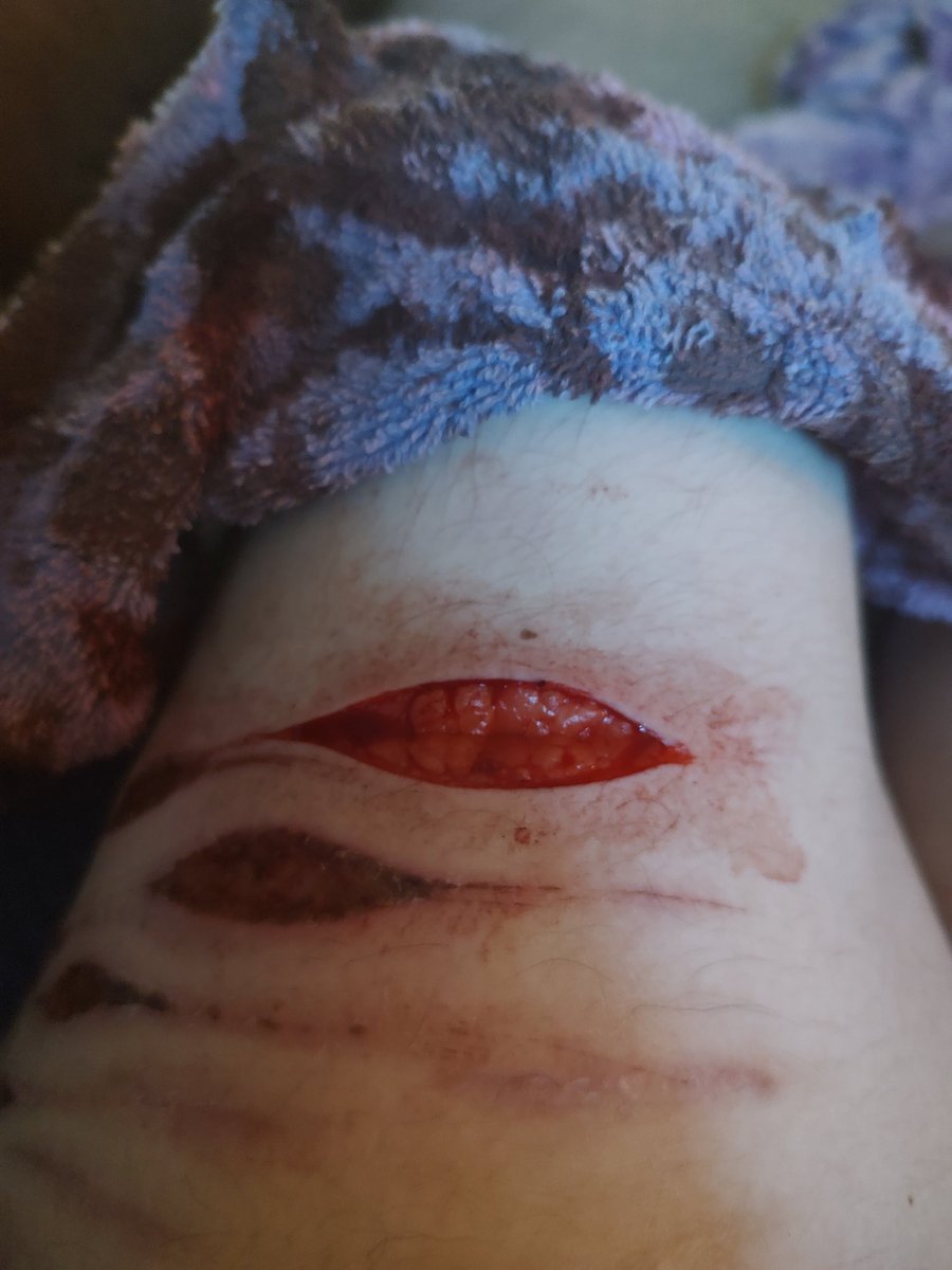 agoogogaga's tweet photo. GUYS WAIT THIS KIND OF LOOKS AWESOME??? #bloodtwt #redinktwt #styrotwt #raspberryfilling #ouchietwt #shtwt #sh #selfharm https://t.co/Ia674ObvLz