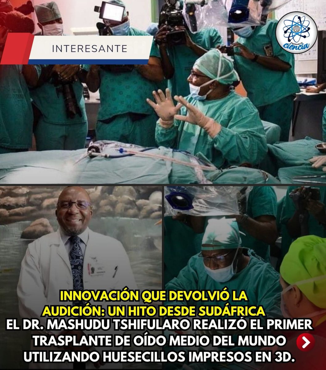 ⚕️👨🏻‍⚕️El cirujano sudafricano Mashudu Tshifularo hizo historia en la medicina moderna al realizar con éxito el primer trasplante de oído medio del mundo utilizando huesecillos impresos en 3D.

La cirugía se llevó a cabo en el Hospital Académico Steve Biko y permitió restaurar la
