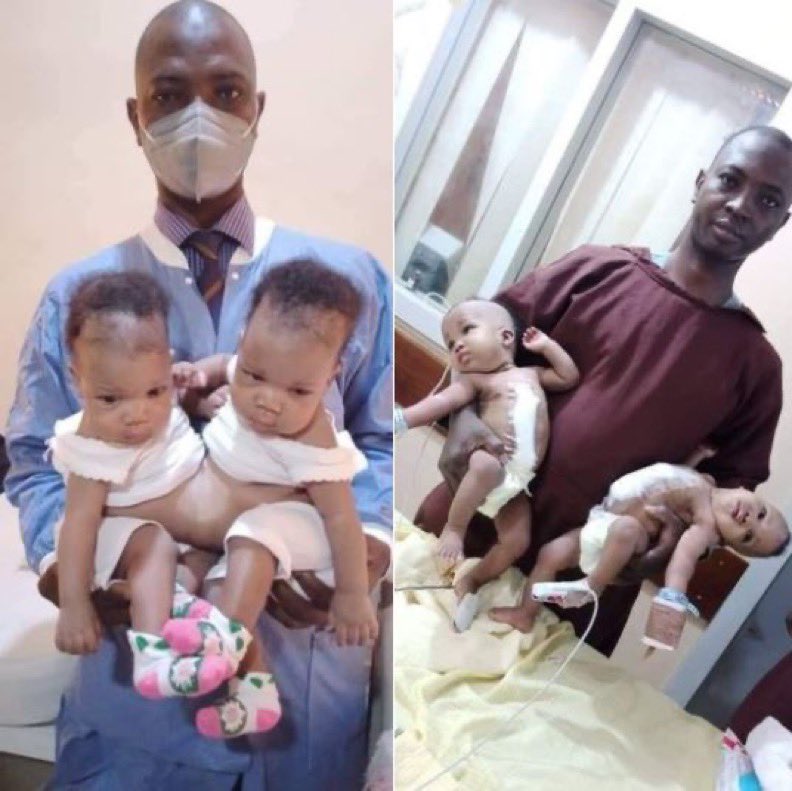whatsappblog9ja's tweet image. Successful separation of conjoined twins at University Of Ilorin Teaching Hospital. Like this post to celebrate them❤️❤️❤️❤️
( Isabella Ned Nwoko #easymoney Manchester United Benue 20th of October )