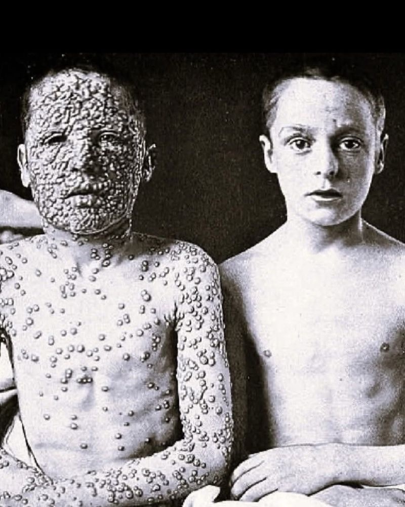 alex_avoigt's tweet image. The difference between vaccinated and unvaccinated

Captured by Dr. Allan Warner at the Leicester Isolation Hospital in England, this haunting image shows two 13-year-old boys who contracted smallpox at the same time, from the same source. Yet, their fates were starkly different.…