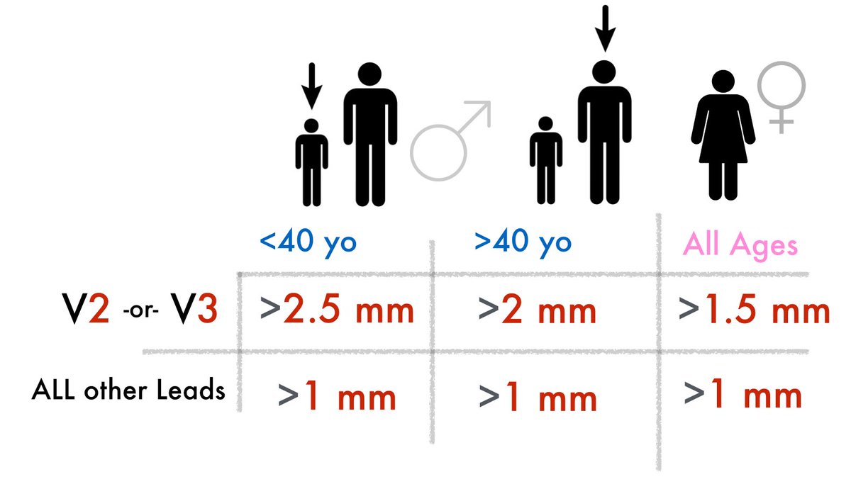 healthefyheart's tweet image. #Quickfact:
#STE significance is also affected by #age and #gender of the #patient (specifically V2/V3). #MedTwitter