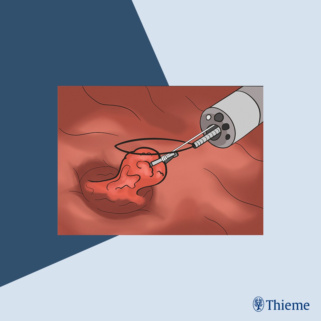#EVideo: Minimally invasive snare traction technique for polyps in the appendix cavity

Find the full text and video here: doi.org/10.1055/a-2602…

Zhiying Gao et al.