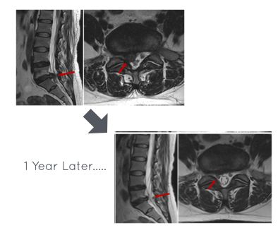 The bigger the disc herniation, the better it shrinks...📉

Spontaneous Disc Regression in different herniations occurs as folllows:
-Sequestration - 96%
-Extrusion - 70%
-Protrusion -41 %
-Disc Bulging -13%

Complete herniation Resolution is seen in
- 43% of Sequestrations 
-