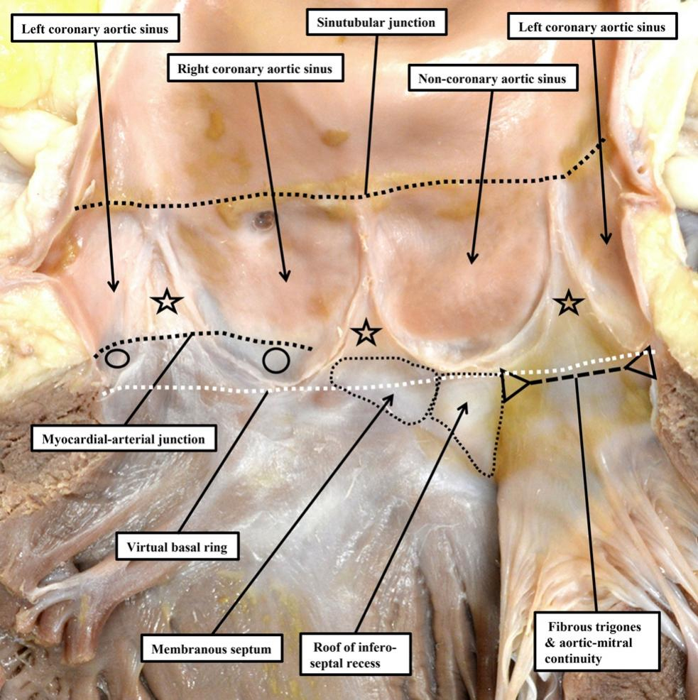 🫀 Anatomy accuracy saves lives!
Prof. Robert H. Anderson calls for precision in describing the aortic root—key to accurate imaging &amp; safer surgery.
#AorticRoot #CardiacAnatomy #CardiacSurgery #MedicalImaging #HeartHealth 

🔗 oaepublish.com/articles/2574-…