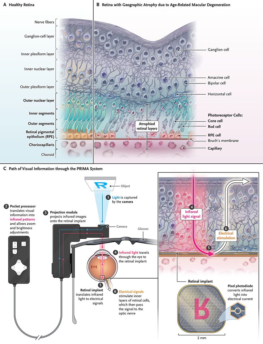 NEJM's tweet photo. Original Article: Subretinal Photovoltaic Implant to Restore Vision in Geographic Atrophy Due to AMD (PRIMAvera study) https://t.co/zCfXDeheYZ  

#AAO2025 | @aao_ophth https://t.co/rHvOQ72Llp