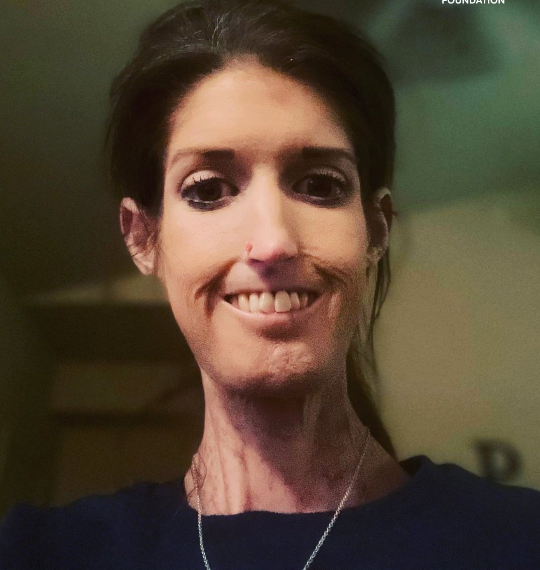 TrackYourHeart's tweet image. This clinical sign is mostly associated with which of the following condition?
A) Sjögren syndrome
B) Scleroderma
C) Dermatomyositis
D) Lupus