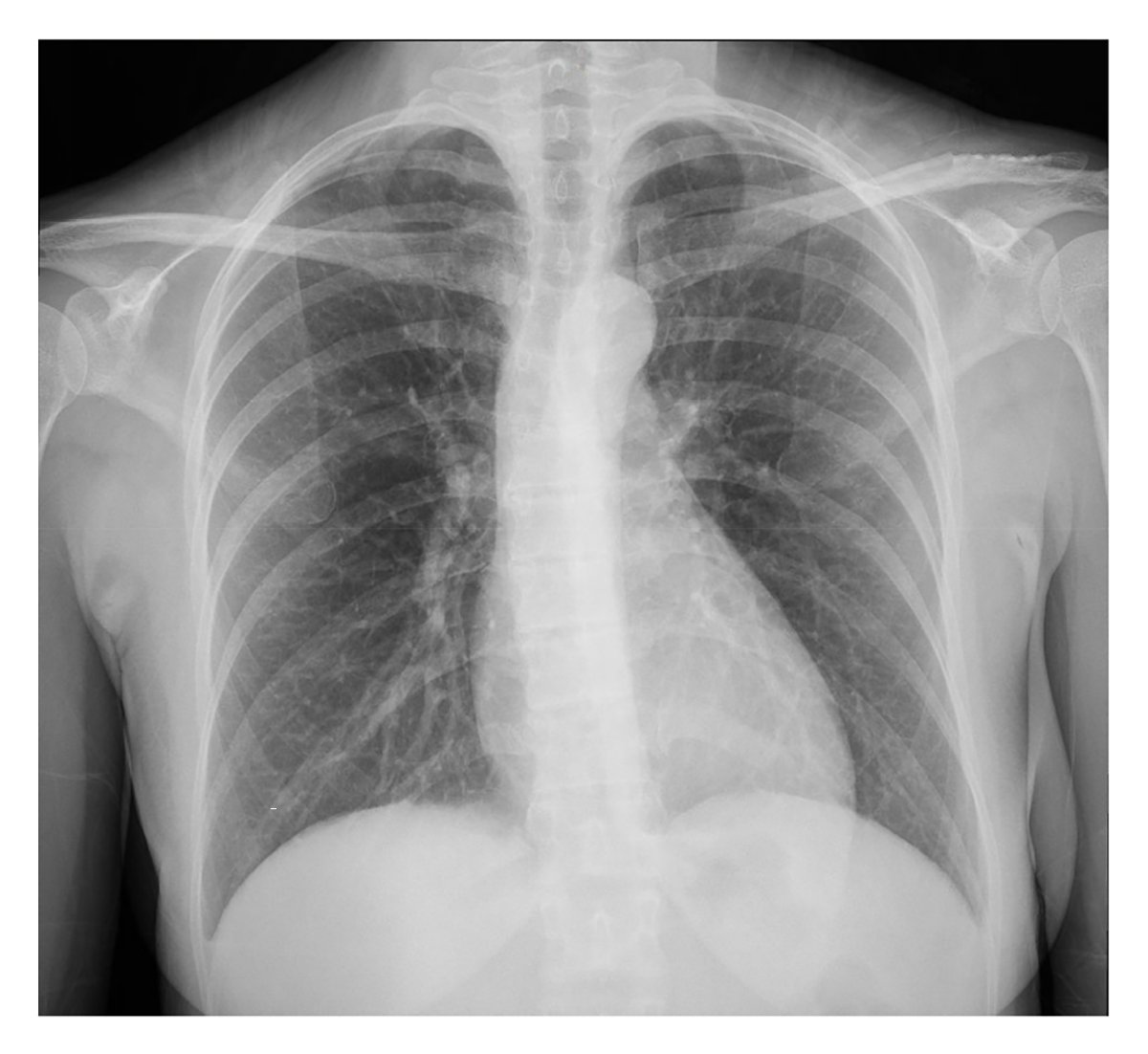 A 40-year-old woman presents with fever, positional chest pain, and symmetric small joint polyarthritis. What is the differential diagnosis? Learn more in a Morning Report: eviden.cc/3Kc0ByA 

<a href="/ImranAziz96/">Imran Aziz</a> <a href="/CookCountyIMR/">Cook County Health Internal Medicine Residency</a> <a href="/KirtanPatolia/">Kirtan Patolia</a>