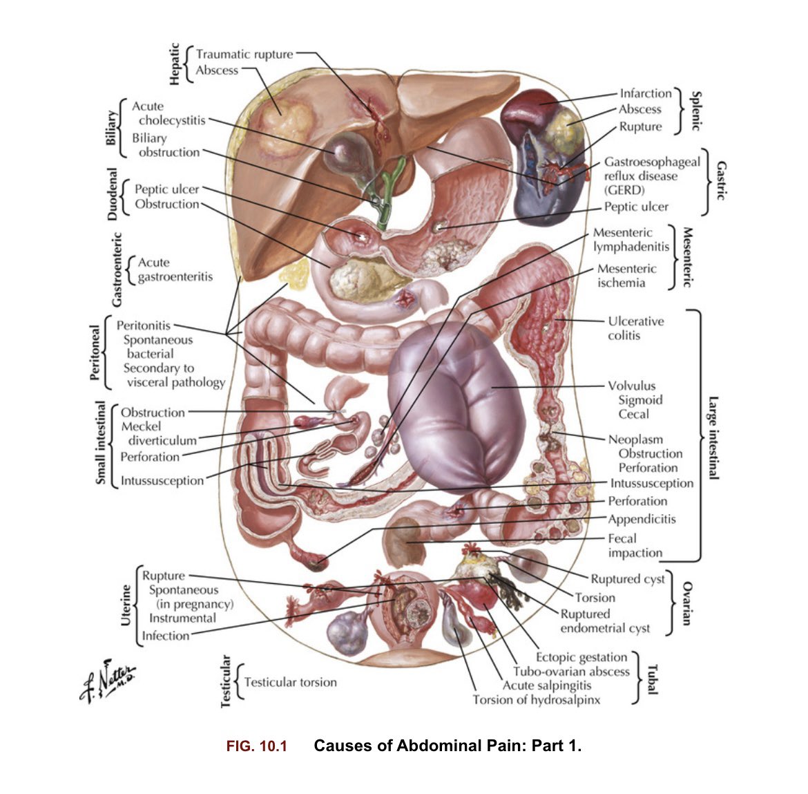 Visual on abdominal pain causes