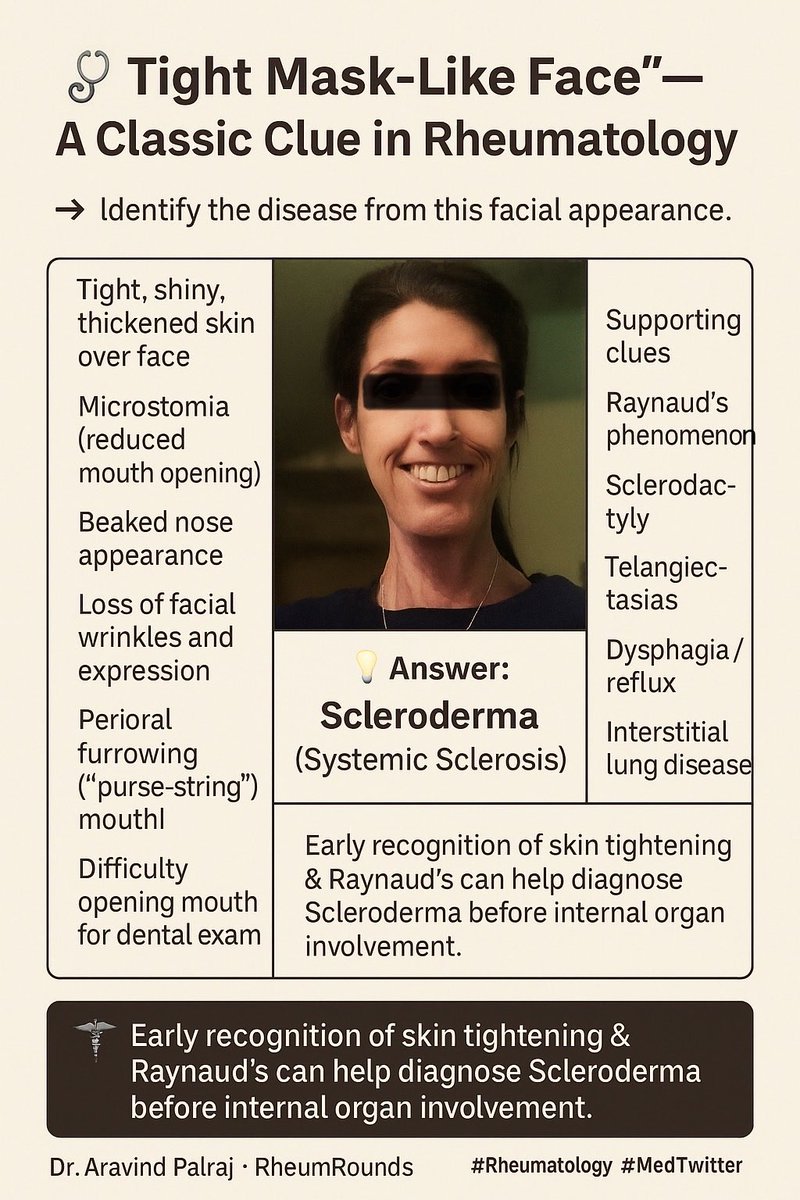 Rheumat_Aravind's tweet image. 👩⚕️ Tight, mask-like face?
Think Scleroderma (Systemic Sclerosis) — not Sjögren’s or Lupus.
Early recognition of skin tightening & Raynaud’s = better outcomes.
#Rheumatology #MedTwitter #Scleroderma #GPs #RheumRounds @DrAkhilX @IhabFathiSulima @Janetbirdope