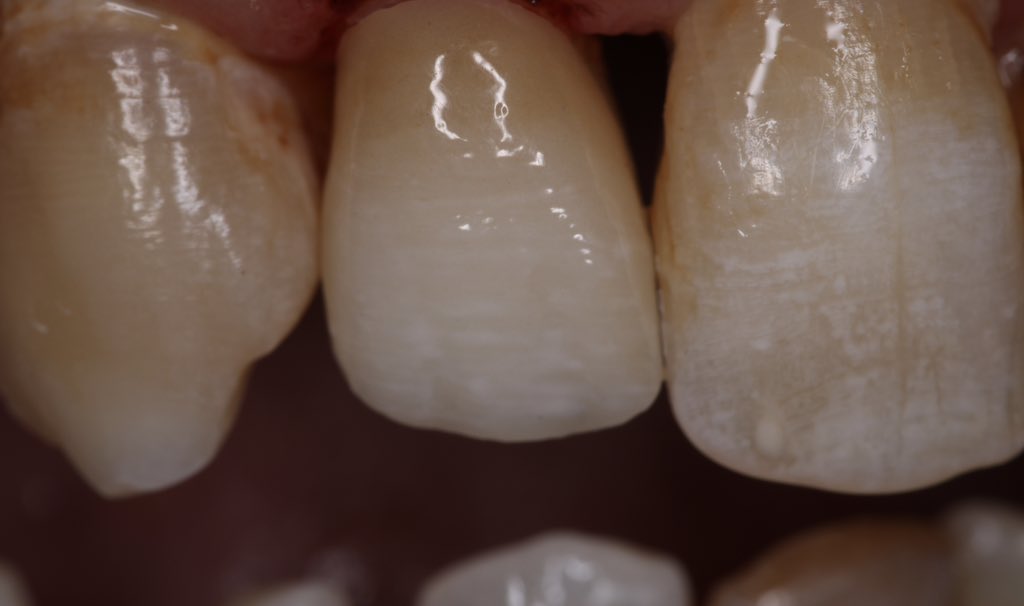 والحمدلله انتهينا بهالنتيجة الجميلة وخاصة تحت إشراف الدكتور عبدالرحمن <a href="/abdulrahmanatq/">Dr. Abdulrahman Almalki د. عبدالرحمن المالكي</a> اللي قدّم لي توجيهات دقيقة في كل خطوة من مراحلها، تعلمت منه الحرص على التناسق مع الابتسامة الطبيعية للمريض. بفضل الله ثم إشرافه وتوجيهه، اكتملت الحالة برضا كبير من المريض وهذا هو الغاية ❤️❤️