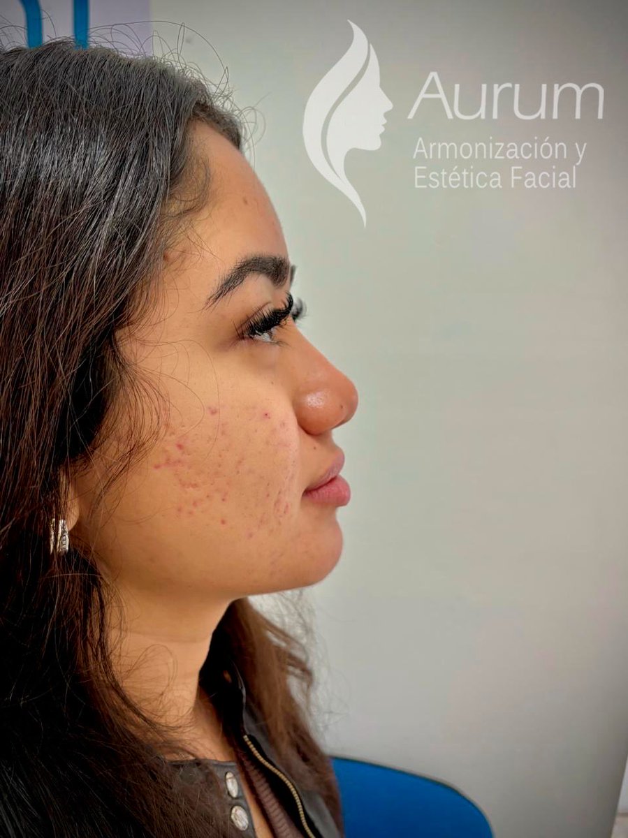 cuident1's tweet image. Rinomodelacion con Ácido Hialuronico
Resultados desde la primera cita y hasta por 18 meses.
Tratamientos personalizados.
#rinomodelacion #acidohialuronico #nariz #armonizacion