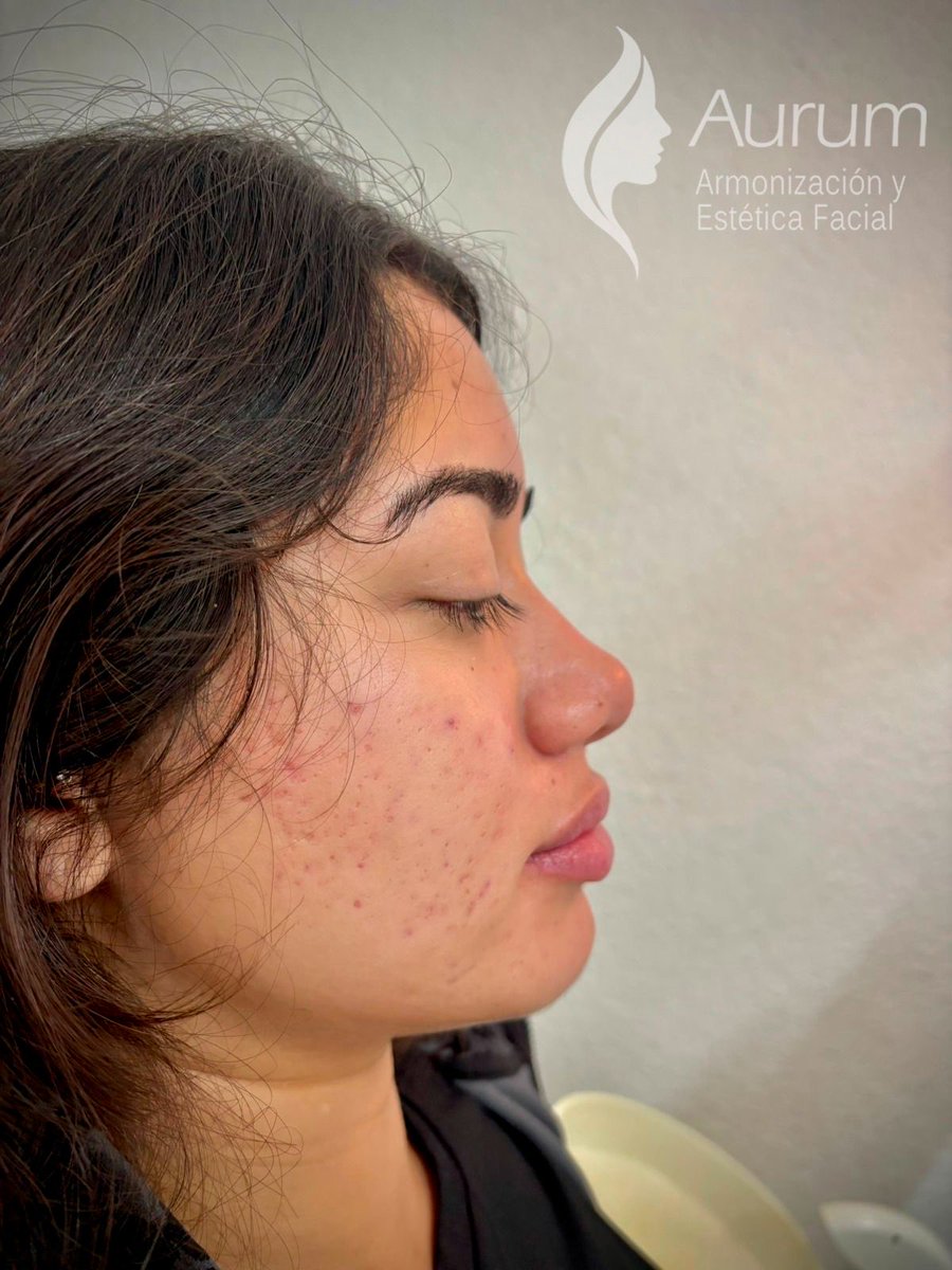 cuident1's tweet image. Rinomodelacion con Ácido Hialuronico
Resultados desde la primera cita y hasta por 18 meses.
Tratamientos personalizados.
#rinomodelacion #acidohialuronico #nariz #armonizacion