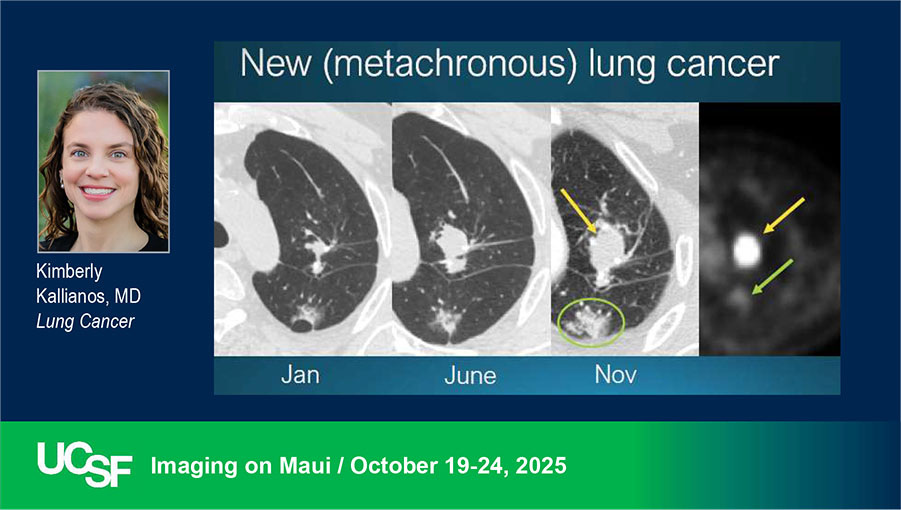 UCSF Thoracic Faculty Dr. Kimberly Kallianos reviews Lung Cancer to start off our week on MAUI. radiology.ucsf.edu/cme