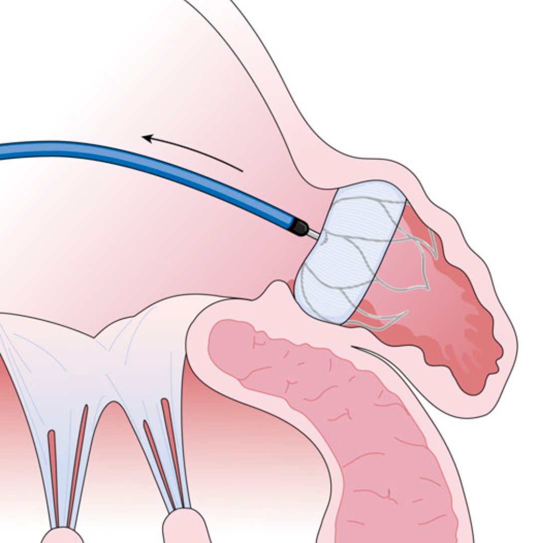 WATCHMAN device positioned in the left atrial appendage.