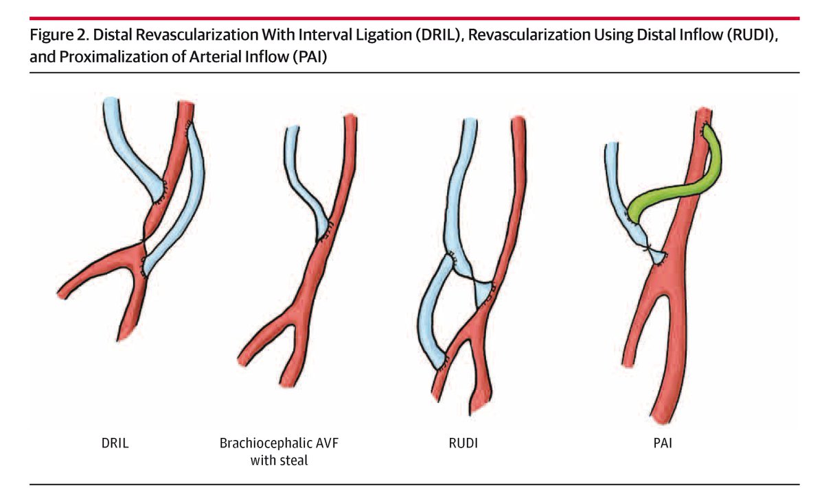 More than 500,000 patients in the US are hemodialysis dependent. 

This Review summarizes current knowledge and recommended strategies for managing well-recognized complications associated with AV access. 

ja.ma/43SiKrQ