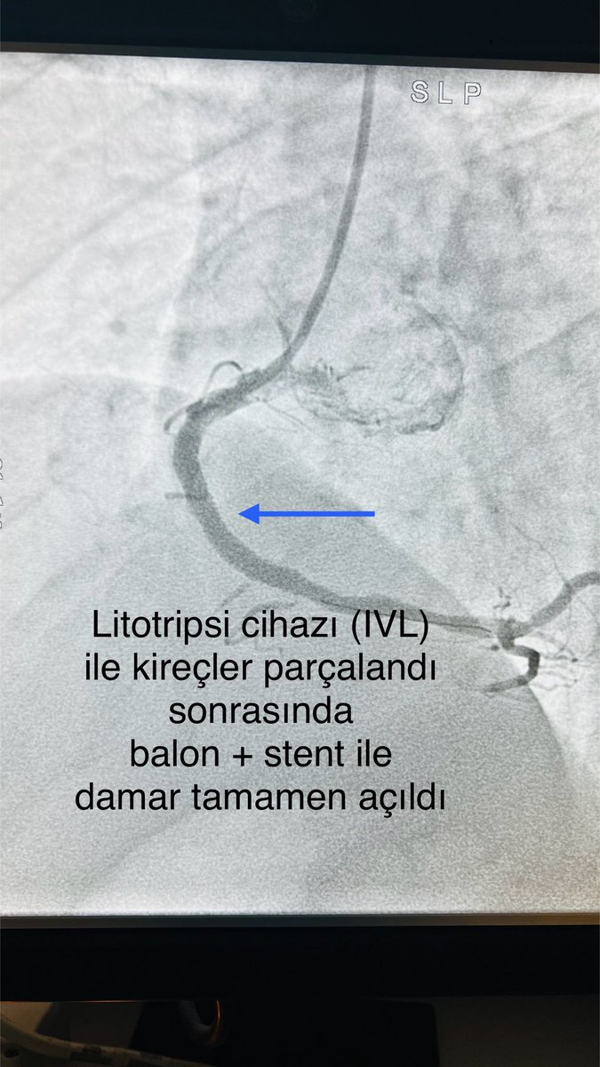 Açılamaz denilen çok kireçli tama yakın tıkalı sağ kalp damarını bu amaçla geliştirilmiş yeni teknolojik bir cihaz (intravasküler litotripsi #IVL) kullanarak, önce damar içindeki kireçleri parçaladık.  Sonra da özel koroner balon ve stent ile damarı tamamen açmayı başardık🫀❤️