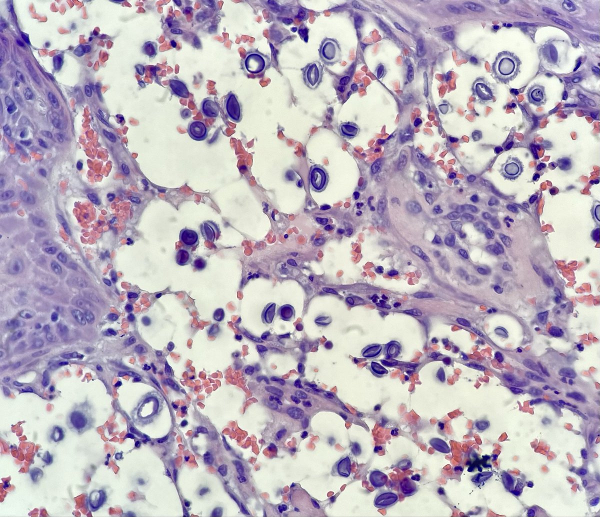 AdrianaHogeboom's tweet image. 70 yo M no relevant PMH. Buccal mucosa ulcer biopsy (see H&amp;amp;E). Waiting on GMS. Do you buy cryptococcus? @ParasiteGal @LangerPath