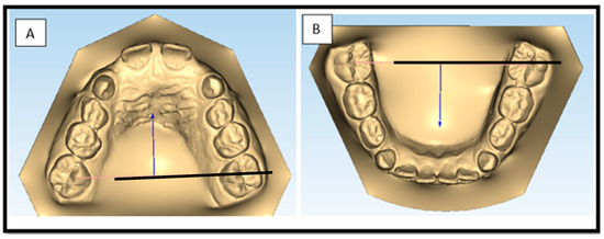 Applsci's tweet photo. ๐ฅ Read our Paper
๐Three-Dimensional Analysis of #Maxillary Expansion during Mixed Dentition: Comparison between Leaf Expander and #AlignersโA Case-Control Study
๐https://t.co/iSd6oHlFm2
๐จโ๐ฌbyย Francesca Silvestrini-Biavati et al.
@UniGenova
#mixeddentition #malocclusion https://t.co/j80yW4uPUO