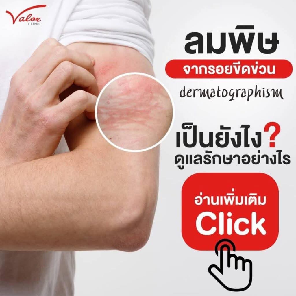 ninggdestiny's tweet photo. มีปัญหา​ผื่นแบบนี้อ่ะ​ รำคาญ​มาก​ ตอนคันเยอะคือหงุดหงิด​ อาจมาจากการพักผ่อนหรอ​ หรืออากาศ​นี่แหละ​ ร้อนชื้น​ฝนตกคืออาการมาทันที https://t.co/bDu8hncOt5