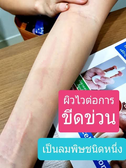 ninggdestiny's tweet photo. มีปัญหา​ผื่นแบบนี้อ่ะ​ รำคาญ​มาก​ ตอนคันเยอะคือหงุดหงิด​ อาจมาจากการพักผ่อนหรอ​ หรืออากาศ​นี่แหละ​ ร้อนชื้น​ฝนตกคืออาการมาทันที https://t.co/bDu8hncOt5