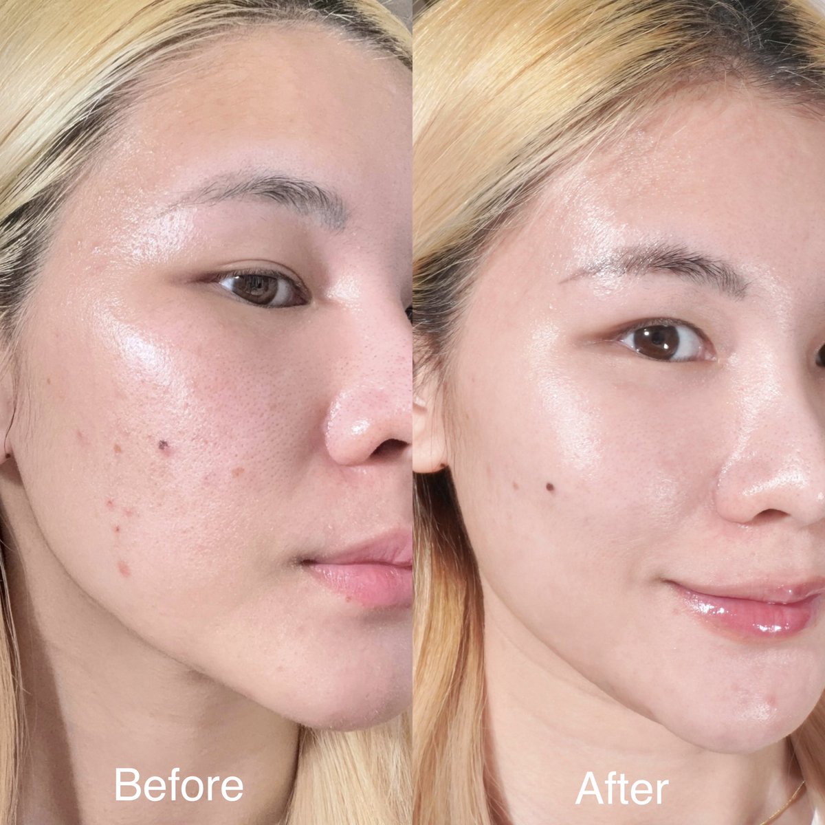 nnannie_e's tweet photo. ใครเป็นสิว/ผิวมัน ใช้อะไรก็แพ้ แนะนำมอยซ์ตัวนี้นะ Effaclar Duo+M เป็นอีกตัวของ La Roche-Posay ที่อยากให้ลองดู ได้ทั้งผิวชุ่มชื้น+ลดสิวอุดตัน สิวอักเสบ จัดการพวกปัญหาสิวขึ้นที่เดิมซ้ำซากดีมาก อีกอย่างคือช่วยลดความมันส่วนเกินบนผิว ใช้แล้วไม่แสบ ไม่คันหน้า ยิ่งใช้คู่กับตัวเซรั่มเค้าก็ดี

- https://t.co/2x1lPy3w7l
- https://t.co/Qm5VdOkOpG