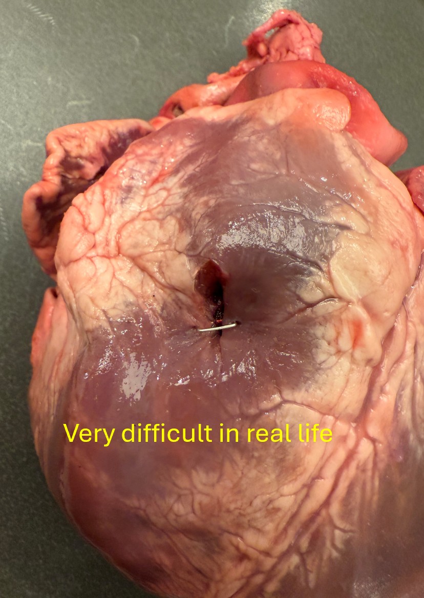 rbarbosa91's tweet photo. Some books describe using a skin stapler to close a cardiac injury.

This is MUCH harder than it sounds because the heart is constantly moving, and the staples just aren't big enough. This was placed in ideal conditions with a stationary heart. Much harder when it's moving. https://t.co/ffeGbUUYJz