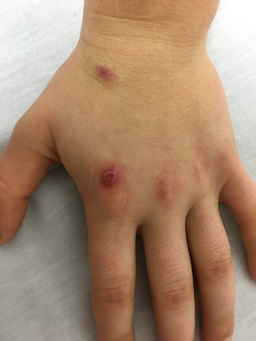 10 años♂️, manipula ganado ovino: 3 días lesión nodular en diana,  y otra maculopápula eritematosa en diferente estadio evolutivo; en la semana previa, adenopatias axilares ipsilateralles.
½

continuum.aeped.es
#pediatria #infecciosas