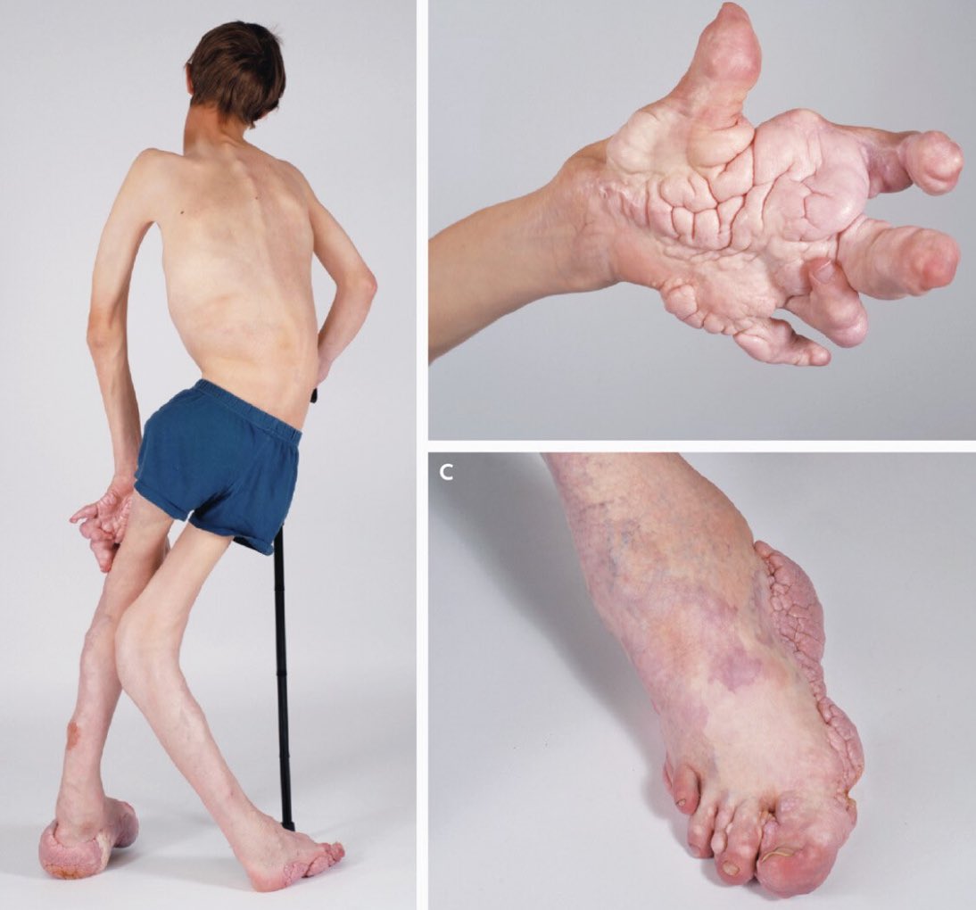marrow_med's tweet image. A boy is brought to the clinic for evaluation of asymmetric limb overgrowth and multiple soft tissue masses as shown. What is the most likely diagnosis?

Image CC: TheKoshurDoc