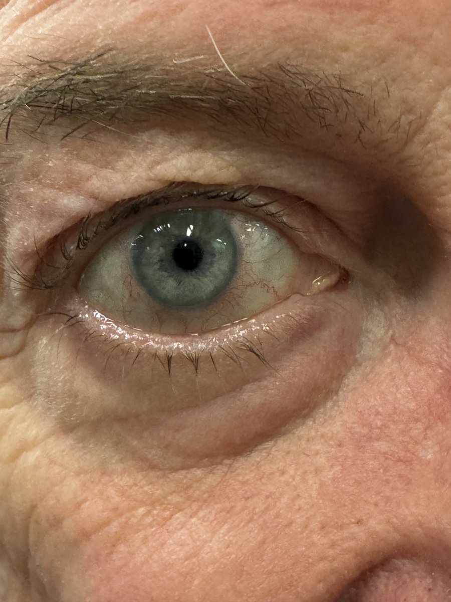 Just had a ‘procedure’ in my bad eye.