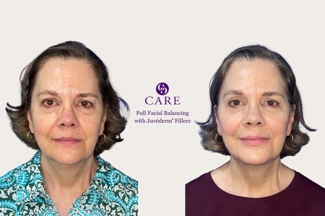 Restore balance + harmony with full facial balancing 💉 Add contour, lift and smooth with Juvéderm filler and Botox for a refreshed you.