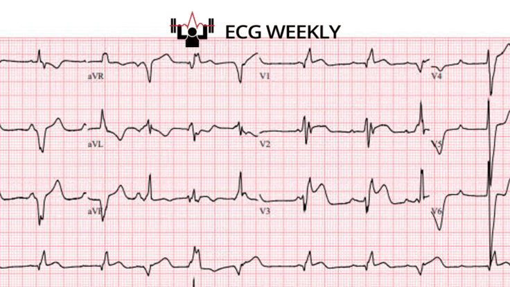 A 64-year-old man arrives to the ED via EMS just after achieving return of spontaneous circulation following cardiac arrest. He received epinephrine, chest compressions, and was defibrillated. The following ECG is obtained immediately on arrival after.....ecgweekly.com/weekly-workout…