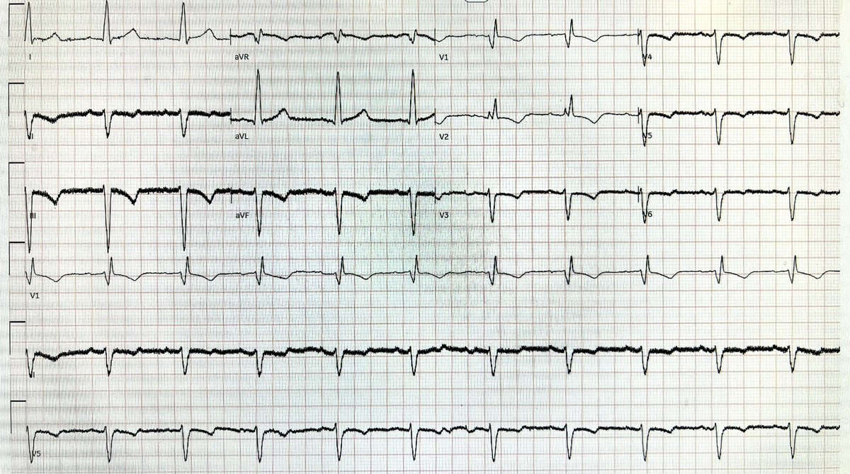 Been a while since I’ve posted a mystery ECG, but this one is too good to pass up.

Hx AFib, with treatment options exhausted, save for pacer/AVN.

Why are they not a candidate for the procedure?

Bonus question: what’s a “hail Mary” strategy we could use to allow pacer/AVN??