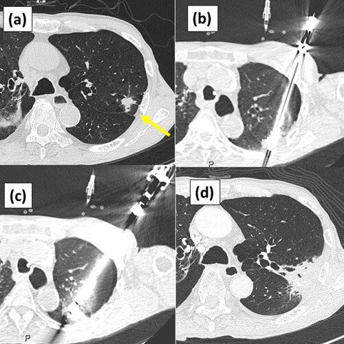 PRNewswireIL's tweet image. #IceCure&apos;s #Cryoablation #System #Combined with #Radiation #Therapy #Successfully #Treats Non-#Small #Cell #Lung #Cancer (#NSCLC) with 92% #Disease-#Specific 5-#year #Survival tinyurl.com/yx6cpady $ICCM @IceCureMedical