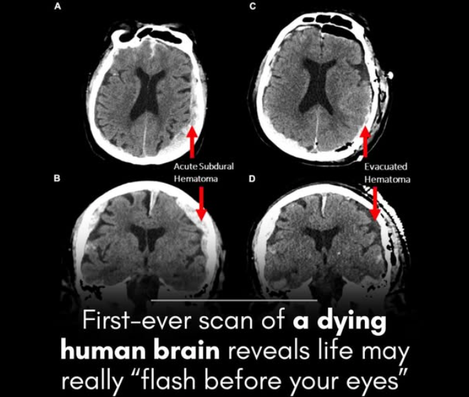 Rainmaker1973's tweet photo. Did you know?

In a study, scientists have recorded the first-ever brain scan of a dying human and waves similar to memory flashbacks appeared.

A man suddenly died during a routine brain scan, revealing intriguing insights into what happens in our final moments.

An 87-year-old man undergoing a routine EEG for epilepsy suffered a fatal heart attack. Researchers found that in the 30 seconds before and after his heart stopped, his brain waves resembled those seen during dreaming, memory recall, and meditation.

This suggests that the commonly reported phenomenon of "life flashing before your eyes" may have a neurological basis. However, since this is a single case study, more research is needed to confirm how common this experience may be.

The findings, published by Dr. Ajmal Zemmar and his team, showed a surge in gamma waves — high-frequency neural oscillations linked to memory and consciousness — just before and after death.
