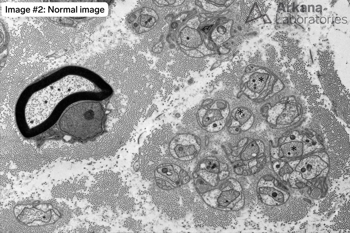 arkanalabs's tweet photo. This 40-year-old patient underwent sural nerve biopsy to evaluate for a painful mixed large fiber and small fiber axonal neuropathy. The biopsy showed light microscopic features of a chronic active axonopathic process. Neurofilament immunohistochemical stain performed on a FFPE tissue section showed diffuse significant loss of small diameter unmyelinated axons.
What are the structures indicated by arrows in Image #1? Once you identify these you will notice multiple other such structures in the image. Image #2 is what normal would look like for comparison.
#NeuroNotes #neuropath #pathx #neuromuscular