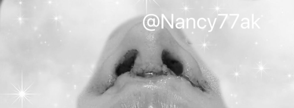 Nancy77ak's tweet photo. 整形垢ご無沙汰😊
この前、人中修正と土手再建してきたよ！
すごくいい感じ💕

（📷写真は手術当日！！グロさ防止で白黒）

鼻の穴の左右差こだわりまくったので
数ヶ所から自家組織を採取してる複合手術だから
DTの腫れ内出血つらい😭

今日はDT3日目でゾンビ過ぎて
また後日纏めよ🧟‍♀️💦

経過楽しみ✨ https://t.co/2t1Iq2jcNL