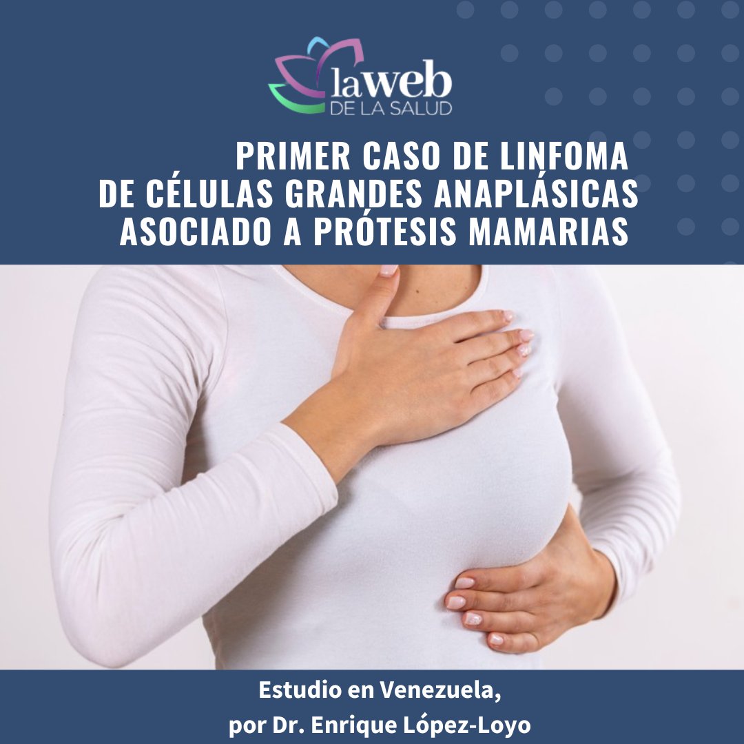 Primer caso diagnosticado en Venezuela de Linfoma de células grandes anaplásicas asociado a prótesis mamarias, estudio publicado en Gaceta Médica de Caracas
<a href="/acamedve1/">Academia Nacional de Medicina de Venezuela</a> <a href="/elopezloyo/">Enrique López-Loyo</a>  <a href="/acfimanve/">Academia Ciencias Físicas, Matemáticas y Naturales</a> <a href="/VivaLaUCV/">Viva la UCV</a> <a href="/UCV_Noticias/">UCV Noticias</a> 
lawebdelasalud.com/linfoma-de-cel…