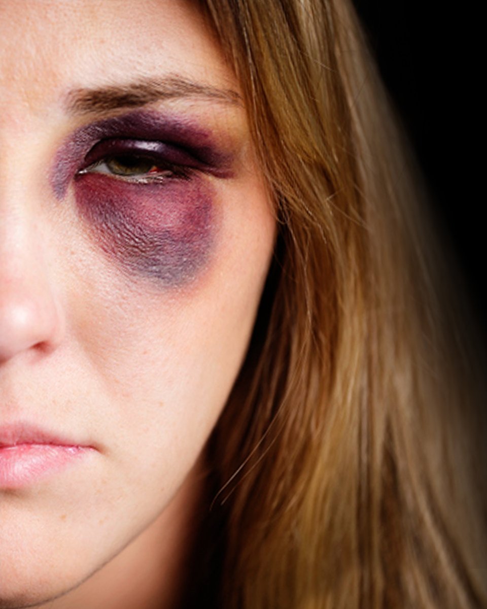 Love Shouldn’t Hurt. Help Is Here. 

November is Domestic Violence Prevention Month. If you or someone you know is experiencing family or domestic violence, please speak up or call for help immediately.

Signs to watch for:
• Unexplained injuries
• Isolation from family and